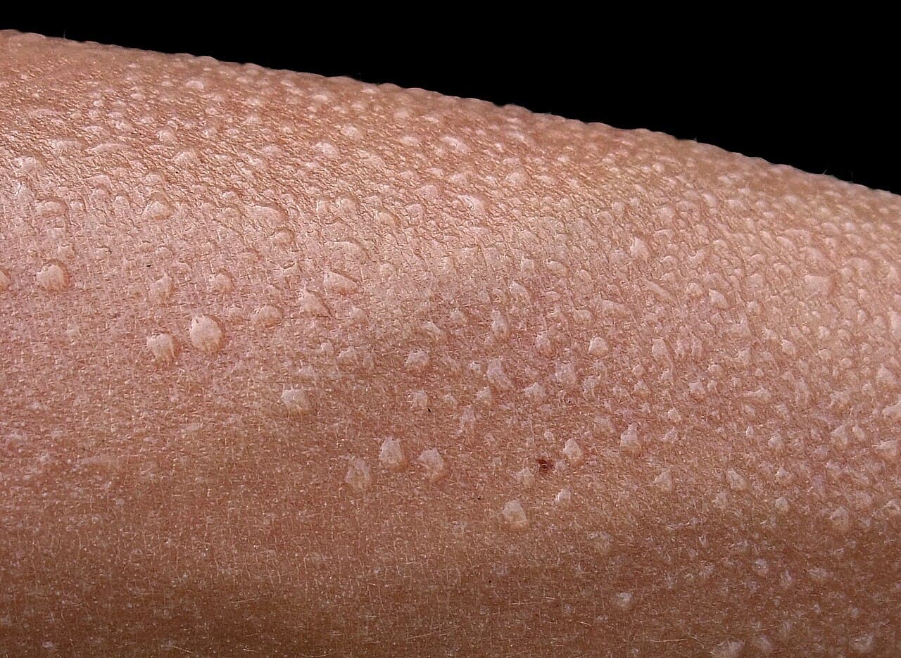 Sudation sur la peau